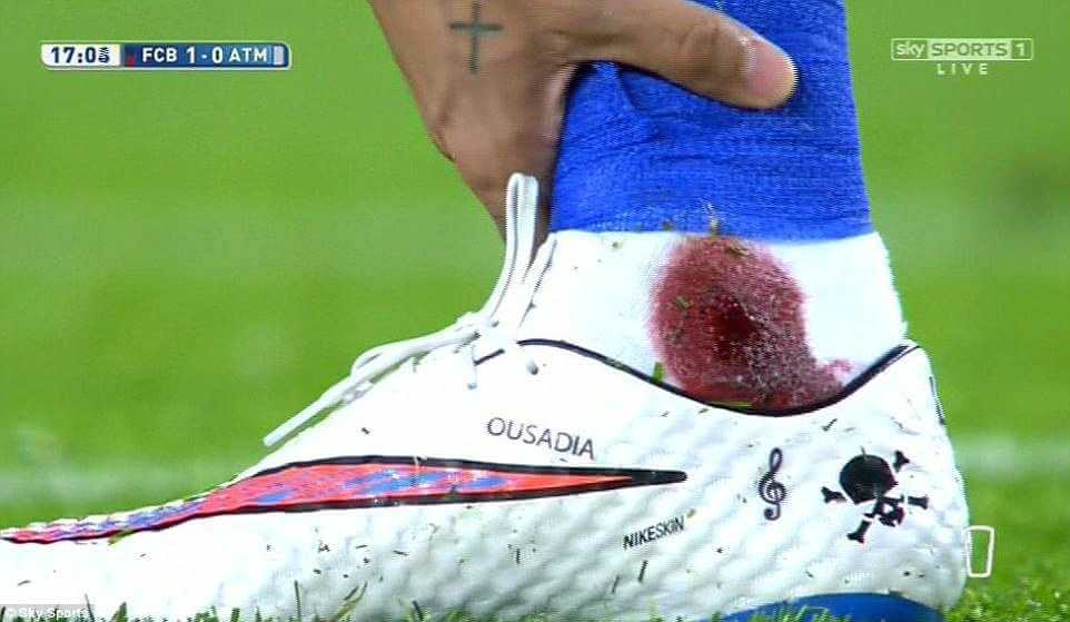 A picture of Neymar's injury